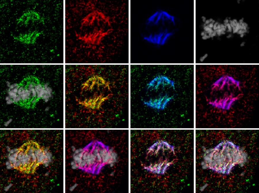 A figura reflicte como se localiza por primeira vez a proteína PIAS2b na división da célula anaplásica do carcinoma. A terapia proposta elimina a proteína desa división, a célula non é capaz de continuar e morre