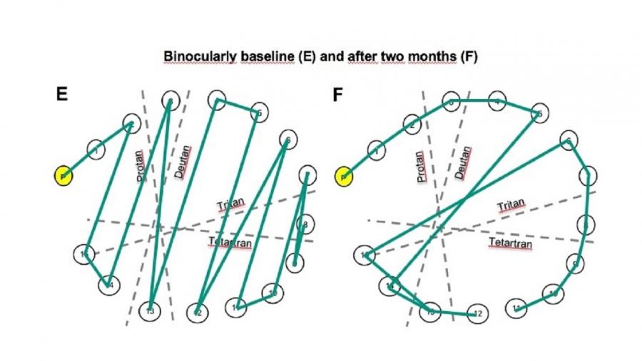Logo de analizar un caso clínico ao longo de dous meses, os investigadores concluíron que a súa mellora na realización de tests de cor era do 60% con filtros haploscópicos