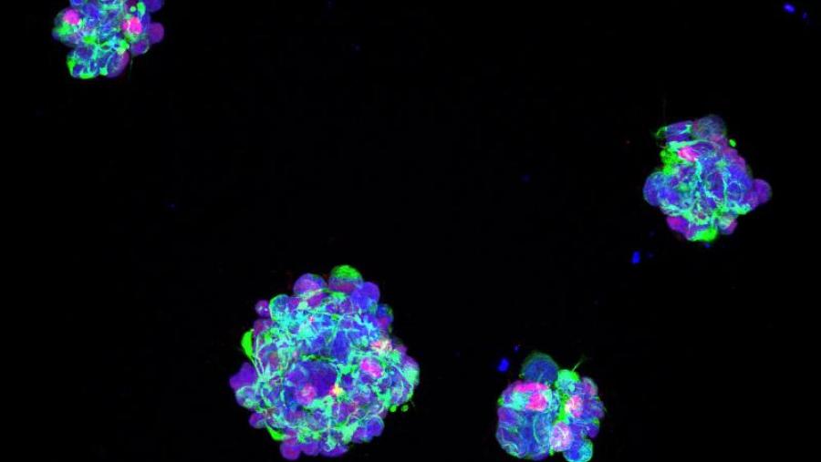 Imagen de microscopia confocal dun cultivo de células iniciadoras de tumor derivadas dun paciente con glioblastoma: Foto: Instituto de Salud Carlos III